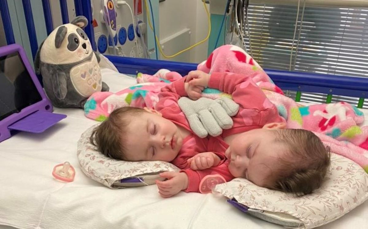 Conjoined twins separated after successful operation